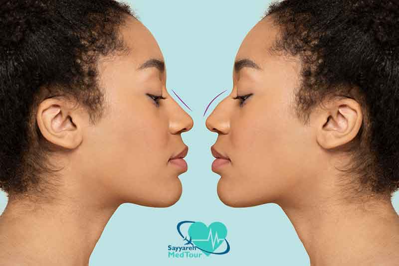Rhinoplasty