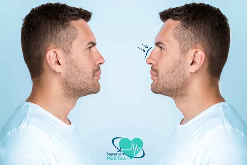 Rhinoplasty